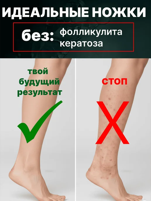 Classica Umbrella Фотоэпилятор лазерный для удаления волос с охлаждением, розовый, фото 4